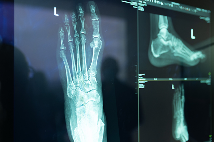 X-Ray image of a patients foot